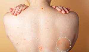 Read more about the article Big Pimple On Back Treatment