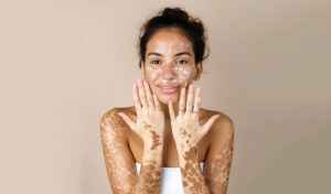 Read more about the article All About Vitiligo: Symptoms, Causes, and Modern Treatments