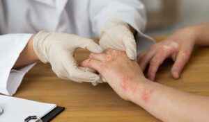 Read more about the article Psoriasis – Types, Causes, Symptoms, Diagnosis and Treatments