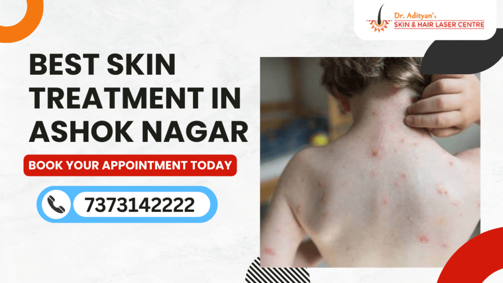 Best Skin Treatment in Ashok Nagar Chennai
