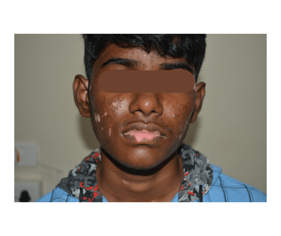 Vitiligo Treatment in Chennai: Regain Your Confidence with Expert Care