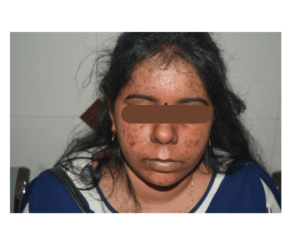 Skin Allergy Treatment in Chennai