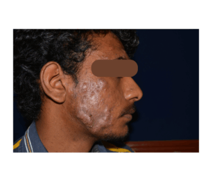 Read more about the article Psoriasis Treatment in Chennai: How Adityan Skin Clinic Can Help You Regain Clear Skin