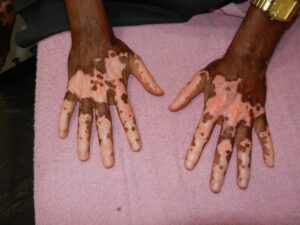 Read more about the article Best Dermatologist in Ashok Nagar Chennai