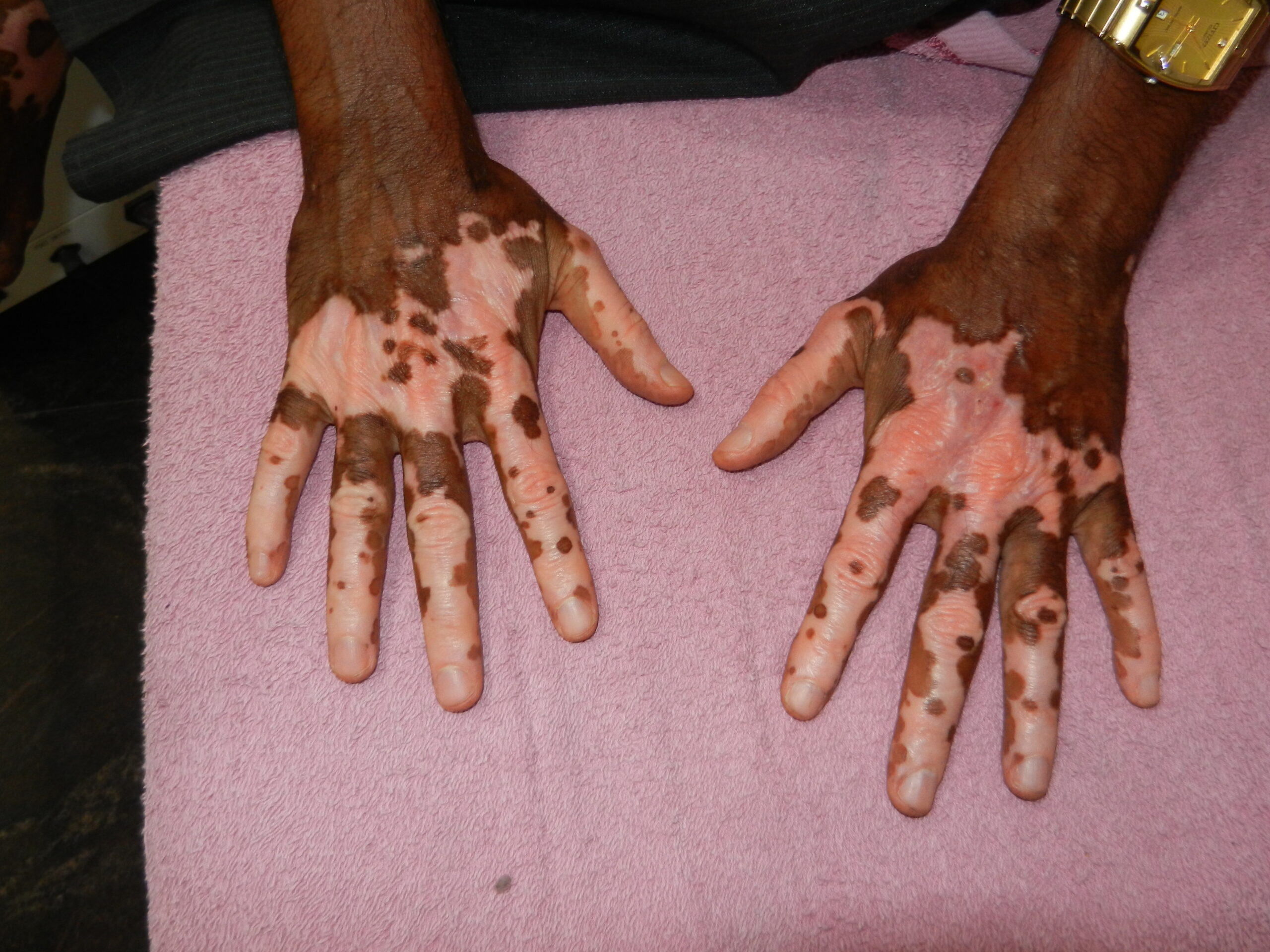 Read more about the article Best Dermatologist in Ashok Nagar Chennai