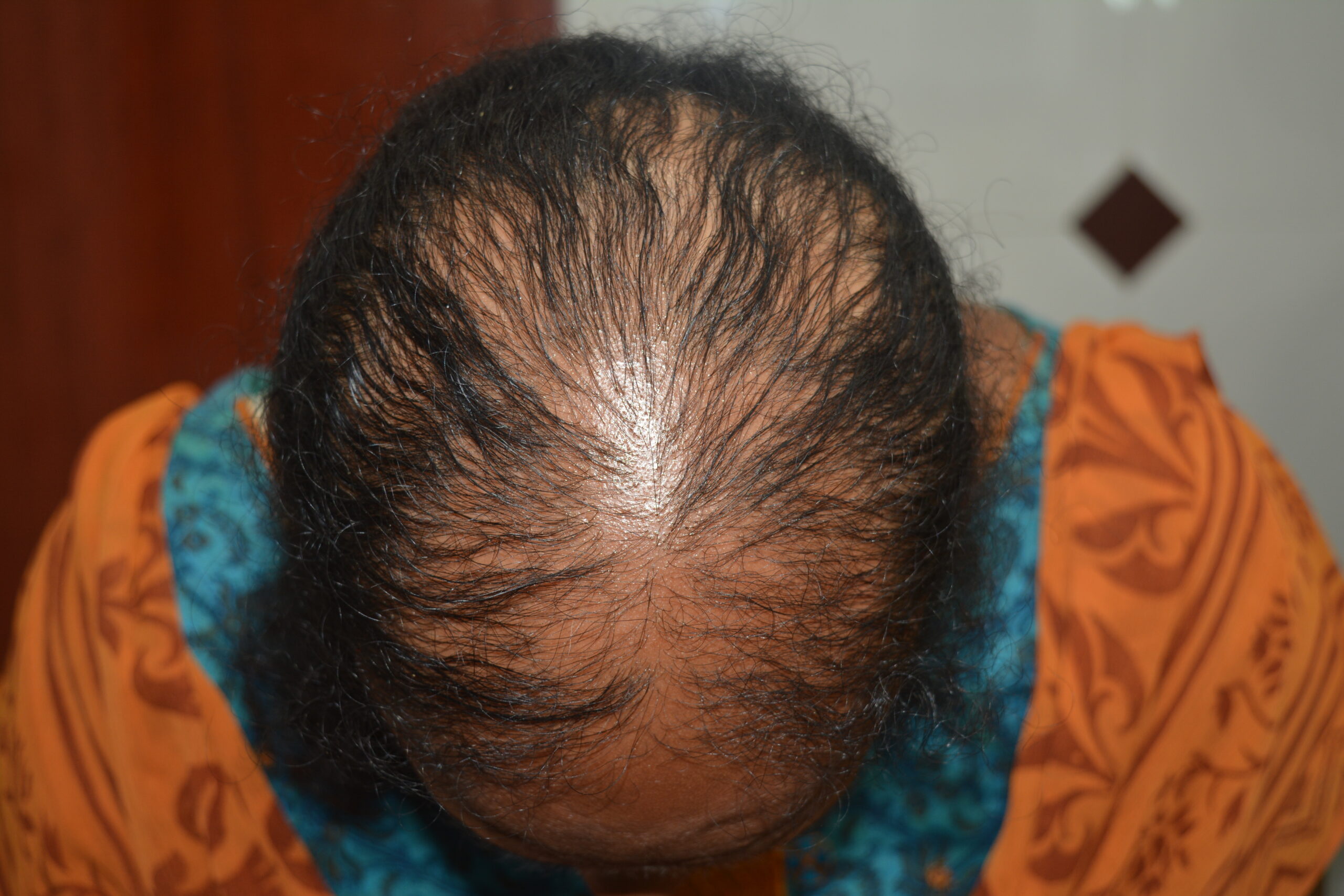 Hair treatment by Best Dermatologist in Madurai