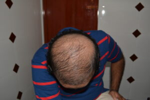 Read more about the article Looking for the Best Hair Clinic near Ashok Nagar? Visit Adityan Skin & Hair Clinic