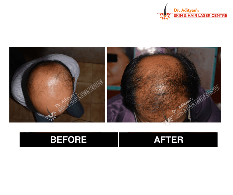 Read more about the article Regain Confidence with the Best Hair Transplant in Chennai – Adityan Skin & Hair Clinic