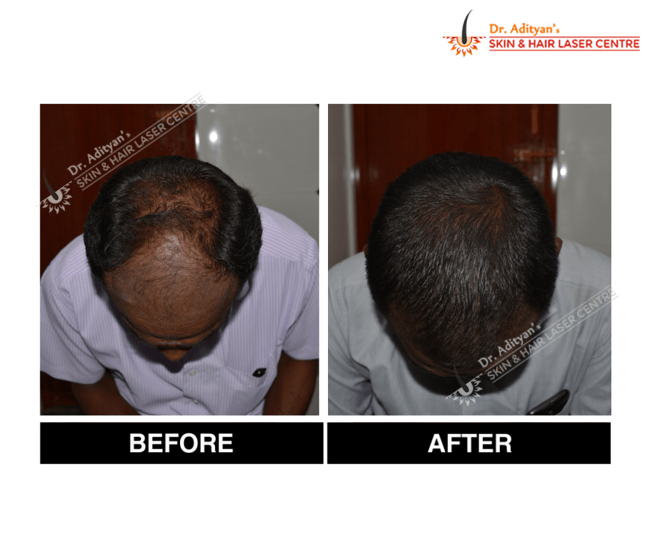 Read more about the article Discover the Best Hair Treatment in Chennai at Adityan Skin & Hair Clinic