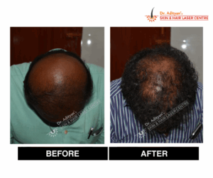 Read more about the article Best Hair Fall Treatment in Chennai at Adityan Skin & Hair Clinic
