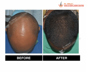 Read more about the article Best PRP Hair Treatment in Chennai – Adiyan Skin Clinic