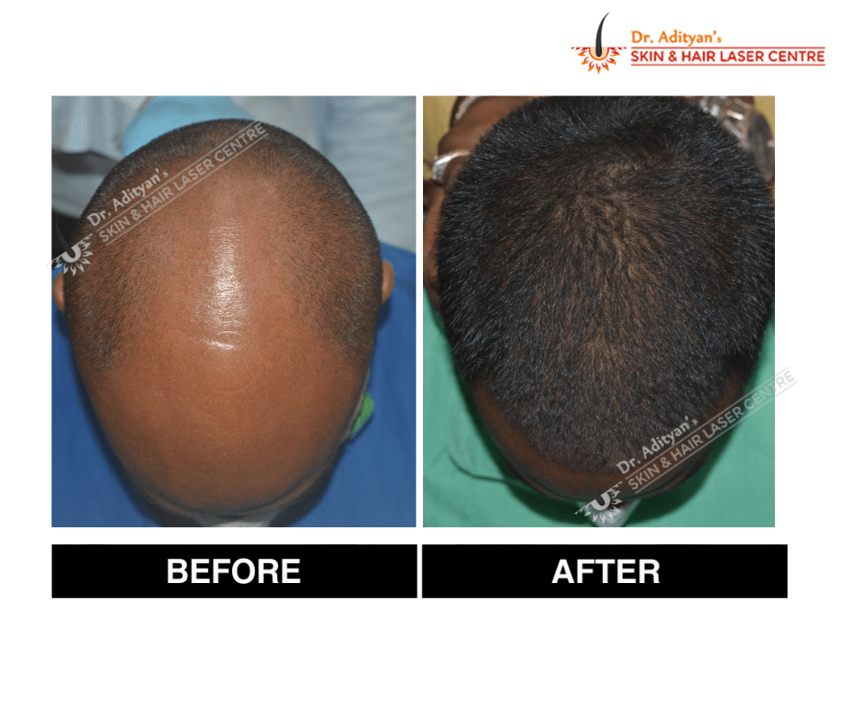 Read more about the article Best PRP Hair Treatment in Chennai – Adiyan Skin Clinic