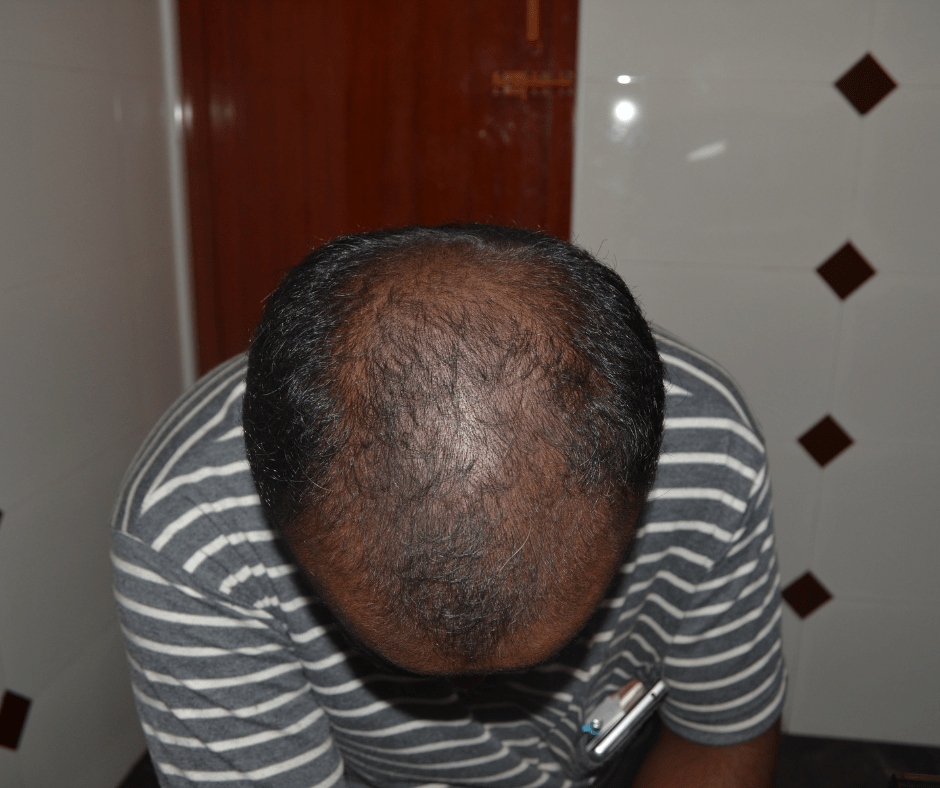 Hair Fall Treatment by best Hair Care Clinic - Adityan Skin and hair laser clinic