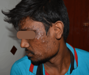 Read more about the article Skin Allergy Treatment in Chennai – Find Expert Relief at Adityan Skin & Hair Clinic