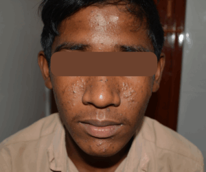 Read more about the article Best skin allergy Treatment in chennai  – At Adityan Skin & Hair Clinic