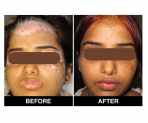 Read more about the article Discover the Best Vitiligo Treatment in Chennai at Adityan Skin & Hair Clinic