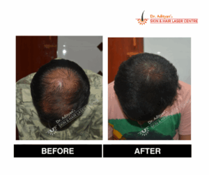 Read more about the article Best Clinic for Hair Transplant in Chennai – Your Guide to Regain Confidence