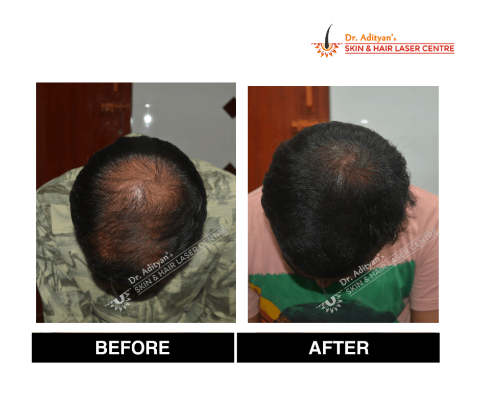 Read more about the article Best Clinic for Hair Transplant in Chennai – Your Guide to Regain Confidence