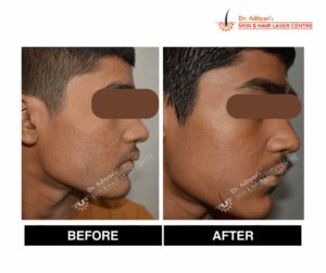 Read more about the article Best Pimple Treatment in Chennai – Clear Skin Solutions at Adityan Clinic