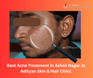Read more about the article Best Acne Treatment in Ashok Nagar at Adityan Skin & Hair Clinic