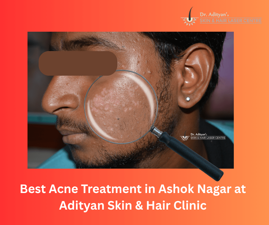 Read more about the article Best Acne Treatment in Ashok Nagar at Adityan Skin & Hair Clinic