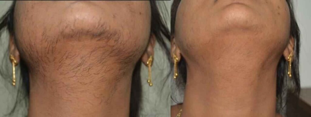 Laser Treatment in Adityan Skin and hair laser clinic