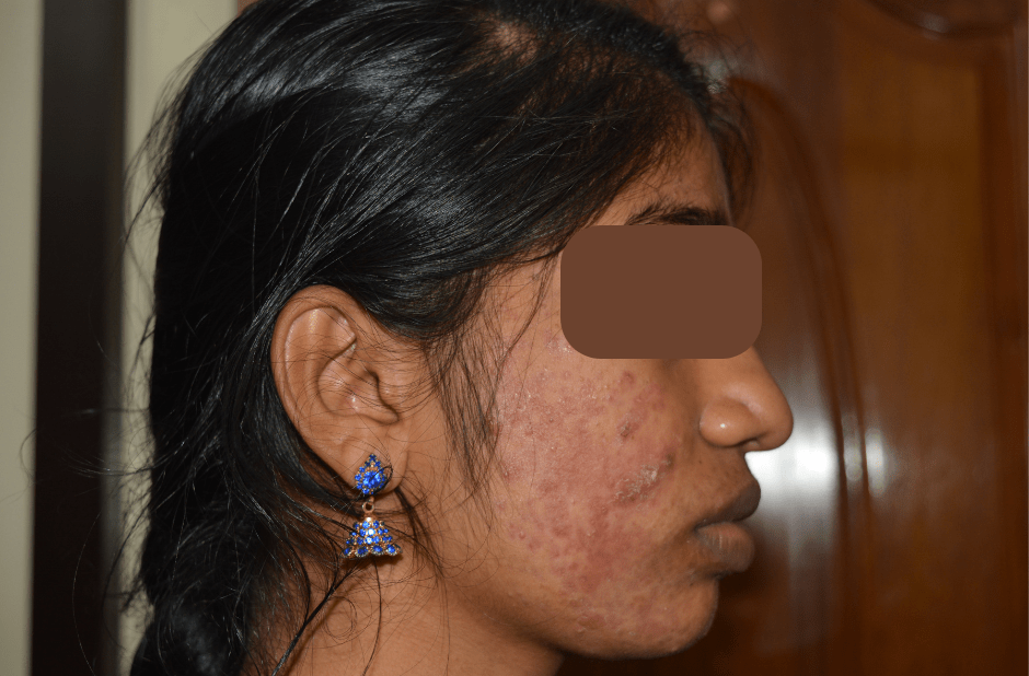 Pimple treatment by dermatologist in Chennai