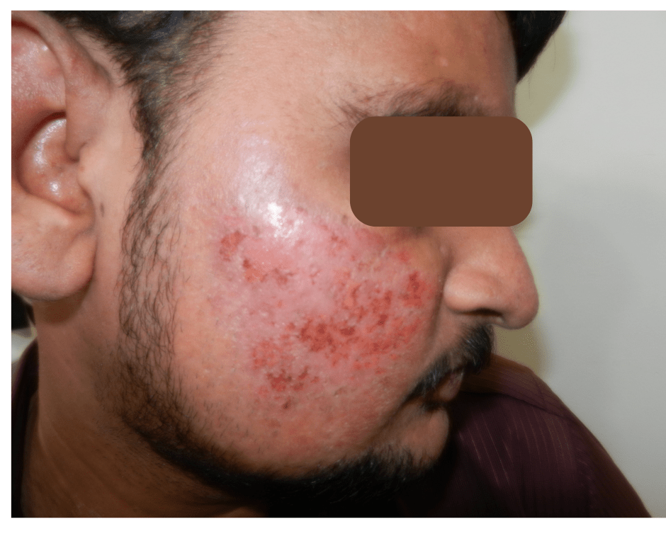 Skin Clinic in Chennai