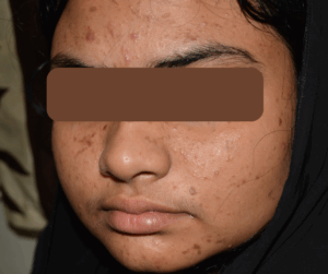 Read more about the article Your Guide to the Best Skin Treatment in Chennai – Visit Adityan Skin & Hair Clinic