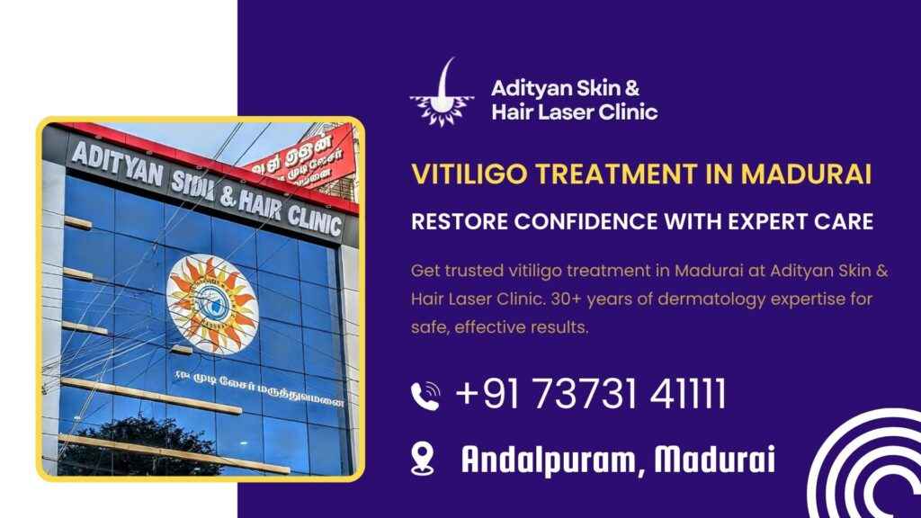 Vitiligo Treatment in Madurai - Adityan Skin and hair laser clinic (1)