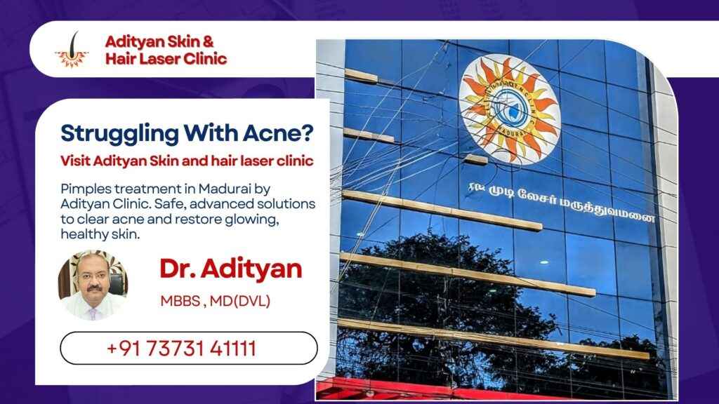 pimples treatment in Madurai - Adityan Skin and hair laser clinic